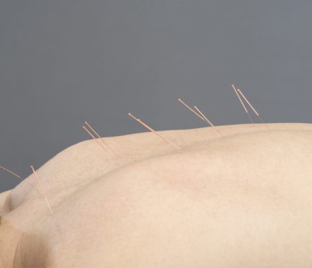 acupunture acupunture
